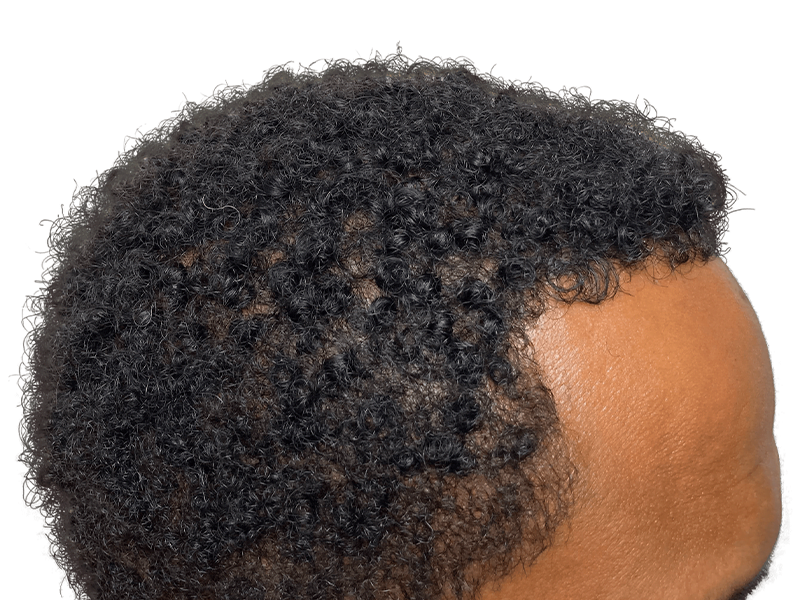 Hair transplant result: African American man's hairline restored. Natural, dense hair growth. Hair restoration success.