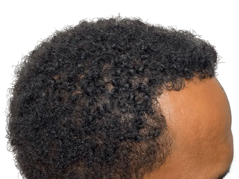 Hair transplant result: African American man's hairline restored. Natural, dense hair growth. Hair restoration success.