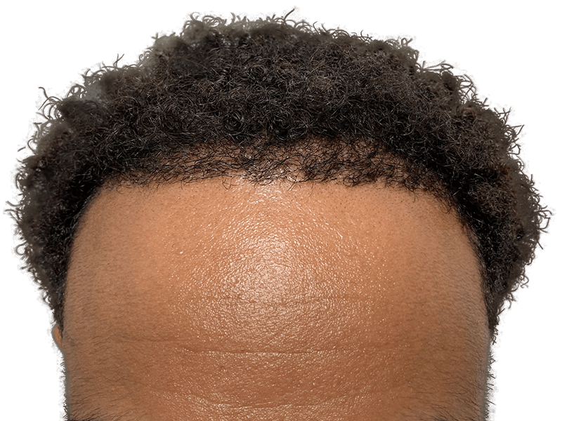 Hair transplant before & after: African American man's restored hairline. Dense, natural-looking results. Hair restoration success.