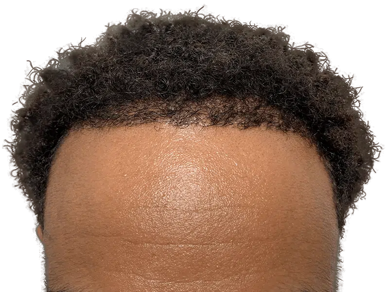Hair transplant before & after: African American man's restored hairline. Dense, natural-looking results. Hair restoration success.