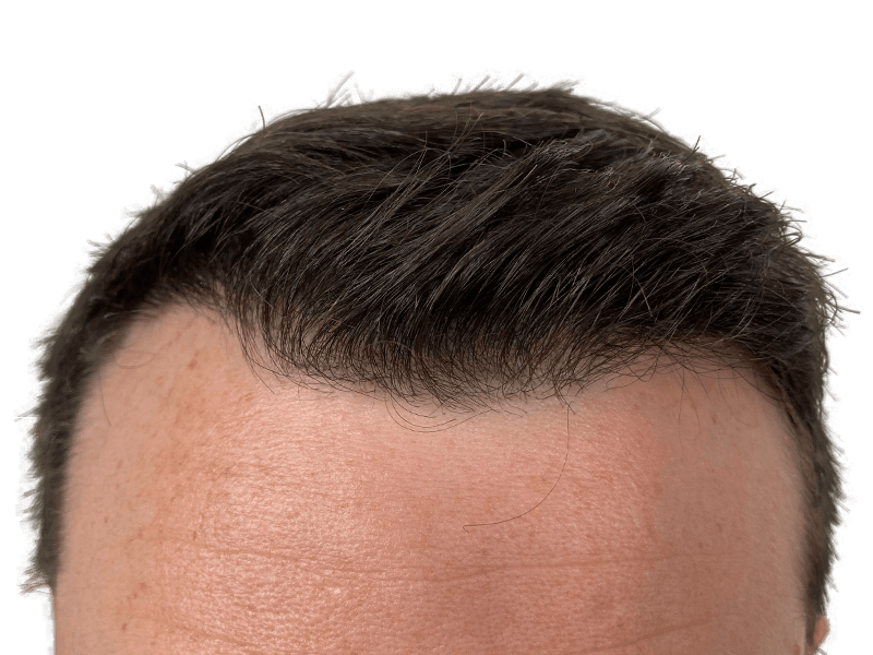 Thinning hairline. Potential hair restoration candidate. Before hair transplant assessment. Dark hair, fair skin.