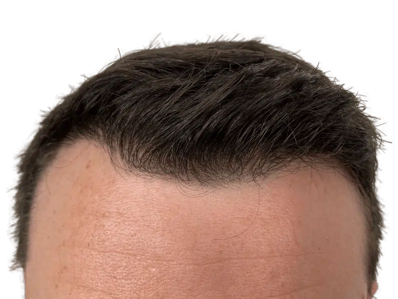 Thinning hairline. Potential hair restoration candidate. Before hair transplant assessment. Dark hair, fair skin.