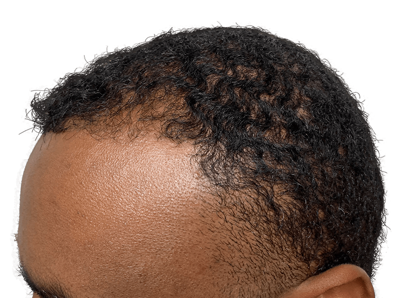 Black man's thinning hairline. Hair restoration/transplant candidate. Before hair transplant assessment.