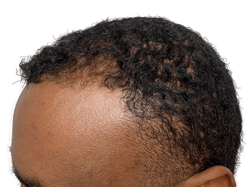 Black man's thinning hairline. Hair restoration/transplant candidate. Before hair transplant assessment.