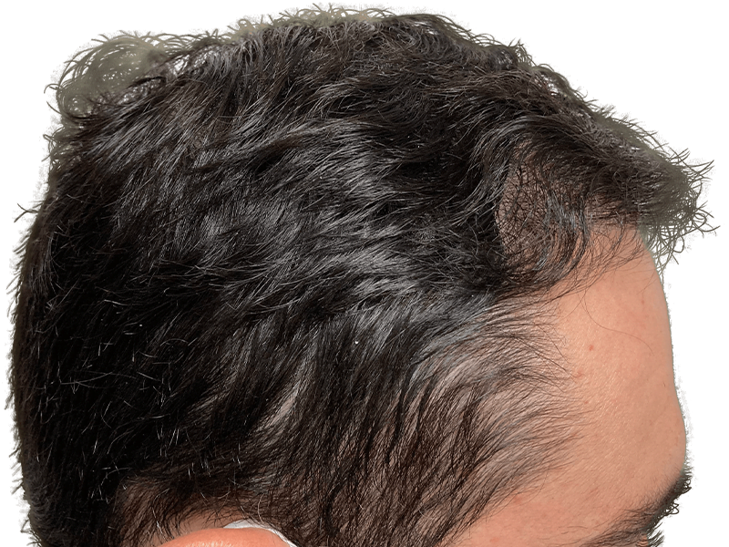 Thinning dark hair at temples, receding hairline. Hair loss example. Consider hair restoration options.