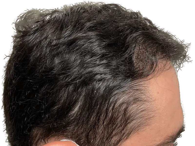 Thinning dark hair at temples, receding hairline. Hair loss example. Consider hair restoration options.