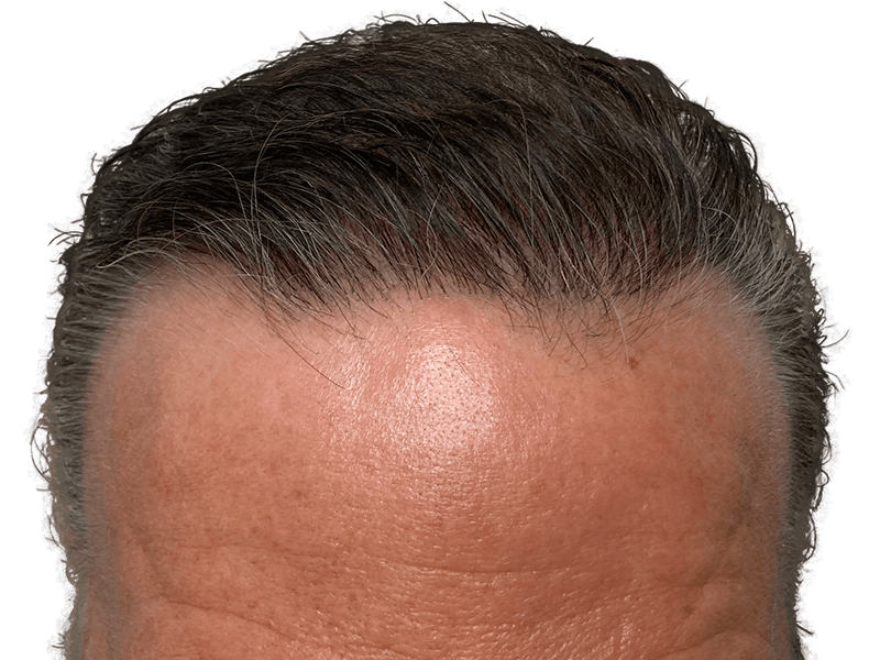 Hair restoration candidate: Graying hairline close-up. Potential hair transplant before/after. Natural-looking hairline.