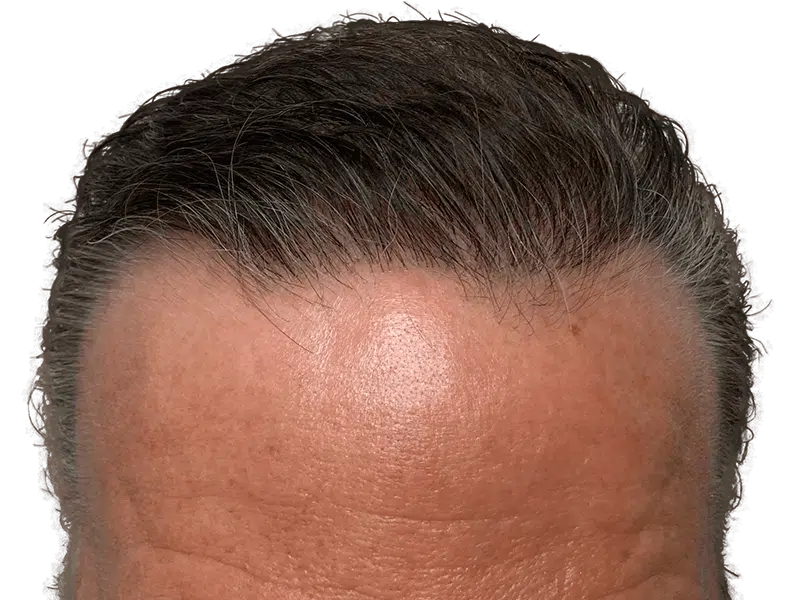 Hair restoration candidate: Graying hairline close-up. Potential hair transplant before/after. Natural-looking hairline.