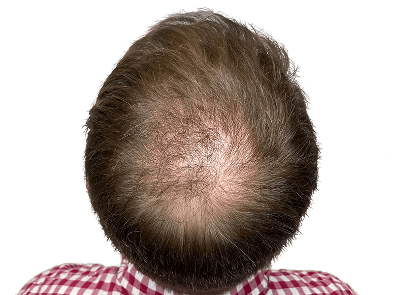 Balding man's crown. Thinning light brown hair. Potential hair transplant candidate. Before hair restoration treatment.