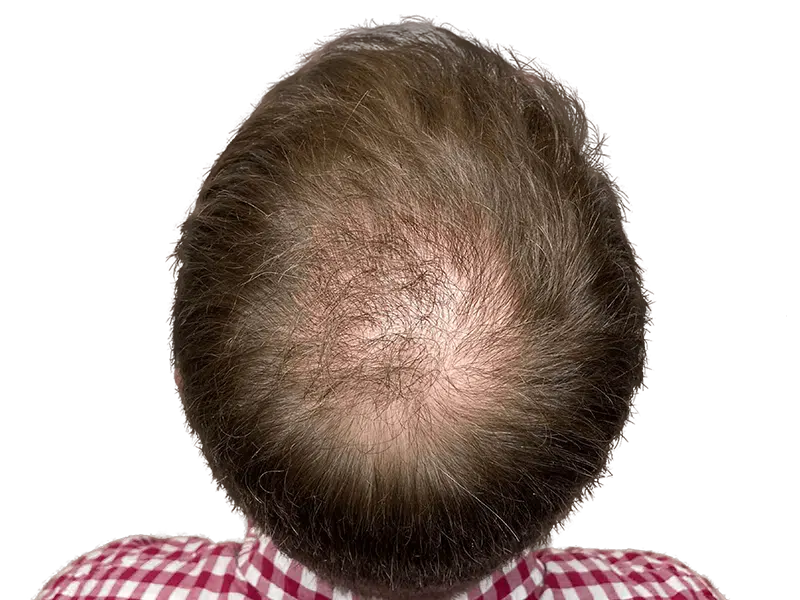 Balding man's crown. Thinning light brown hair. Potential hair transplant candidate. Before hair restoration treatment.