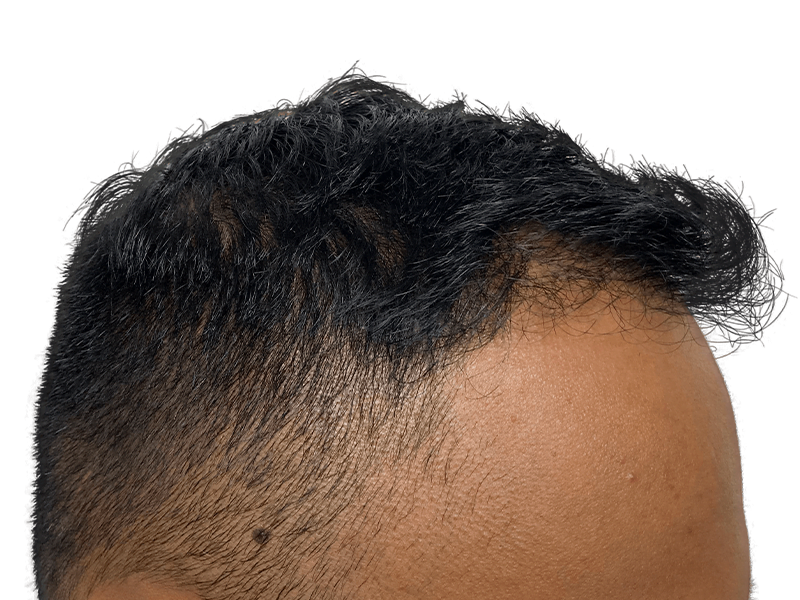 Receding hairline (Asian male). Thinning hair, potential regrowth. Hair restoration/transplant candidate. Before treatment.