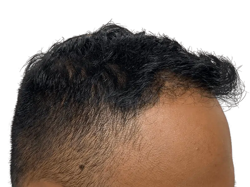 Receding hairline (Asian male). Thinning hair, potential regrowth. Hair restoration/transplant candidate. Before treatment.