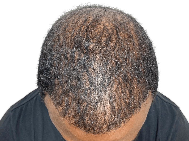 Before hair transplant: Thinning hair on Black/Hispanic man. Hair restoration candidate showing scalp visibility.
