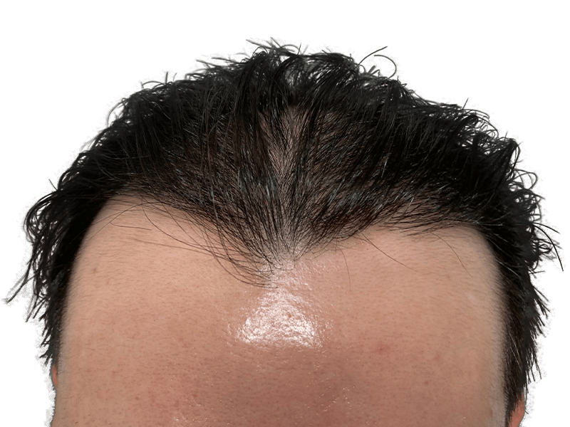 Thinning dark hair at hairline. Potential hair restoration candidate. Before hair transplant consideration.