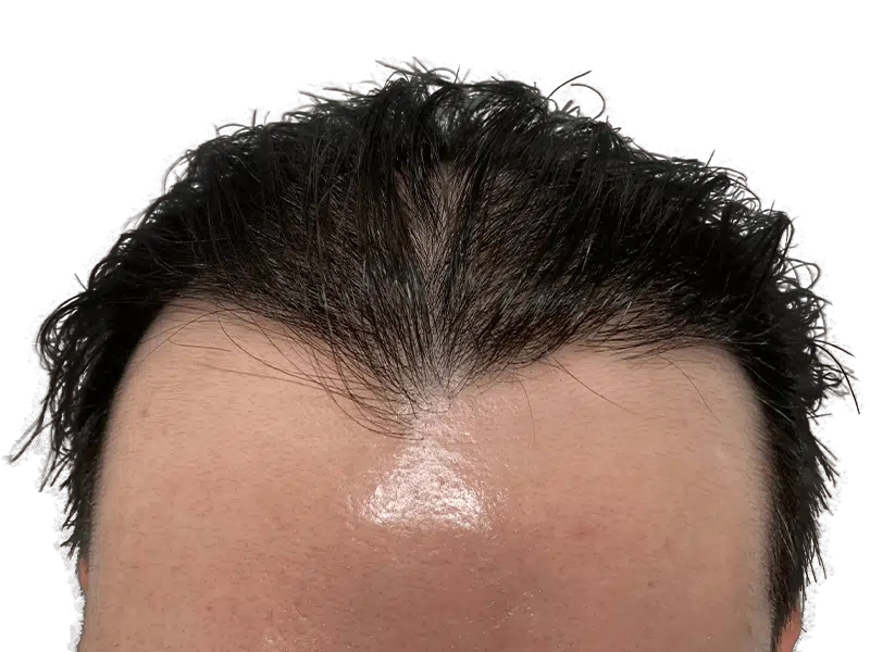 Thinning dark hair at hairline. Potential hair restoration candidate. Before hair transplant consideration.