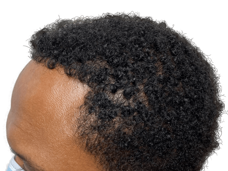 African American man's hairline. Potential hair transplant candidate. Receding hairline, dense textured hair. Hair restoration options.