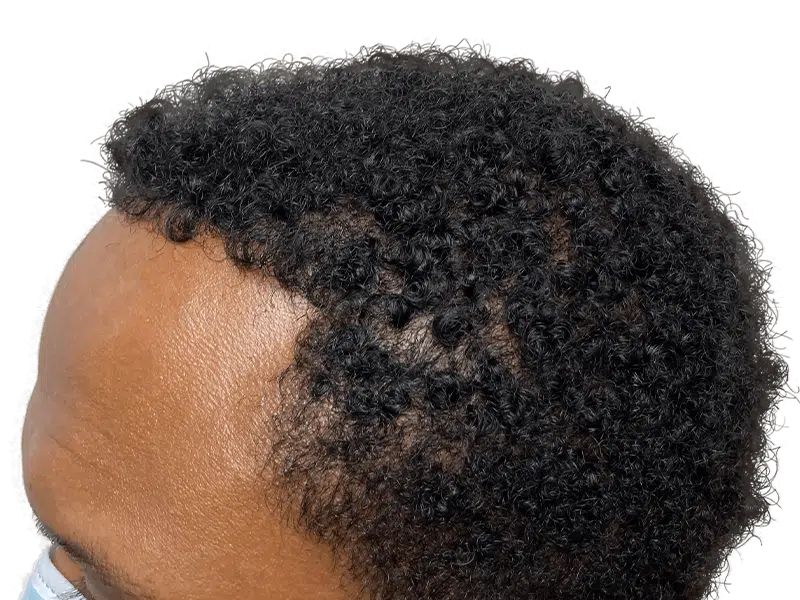 African American man's hairline. Potential hair transplant candidate. Receding hairline, dense textured hair. Hair restoration options.