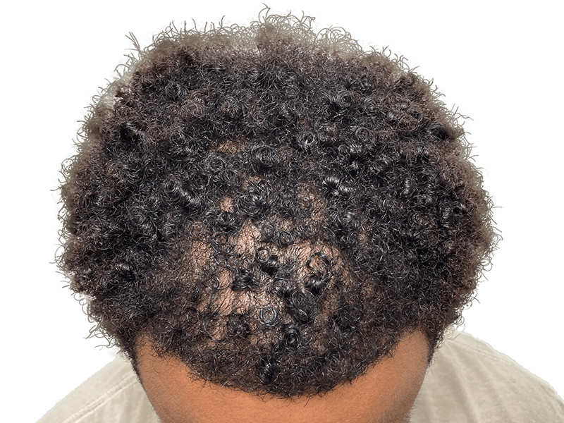 Hair thinning in Black/Hispanic hair. Possible hair transplant area. Hair restoration consultation needed.