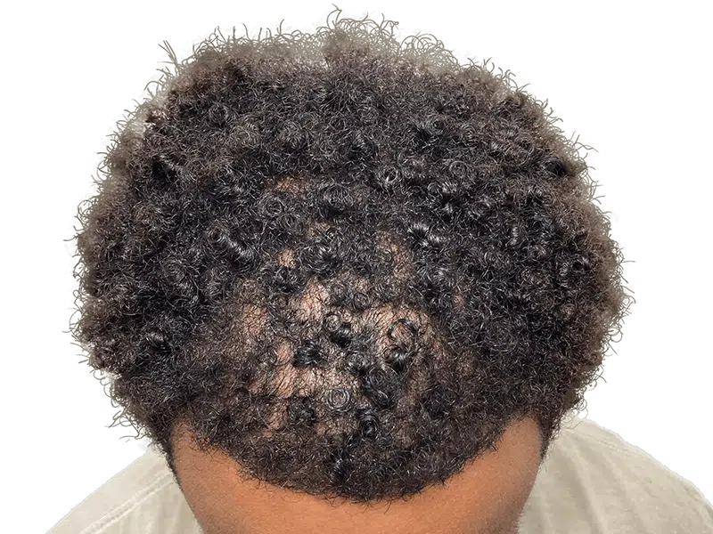 Hair thinning in Black/Hispanic hair. Possible hair transplant area. Hair restoration consultation needed.