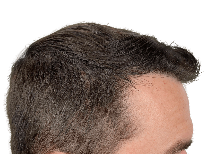 Receding hairline. Potential hair transplant candidate. Hair restoration before/after example. Dark brown hair, fair skin.