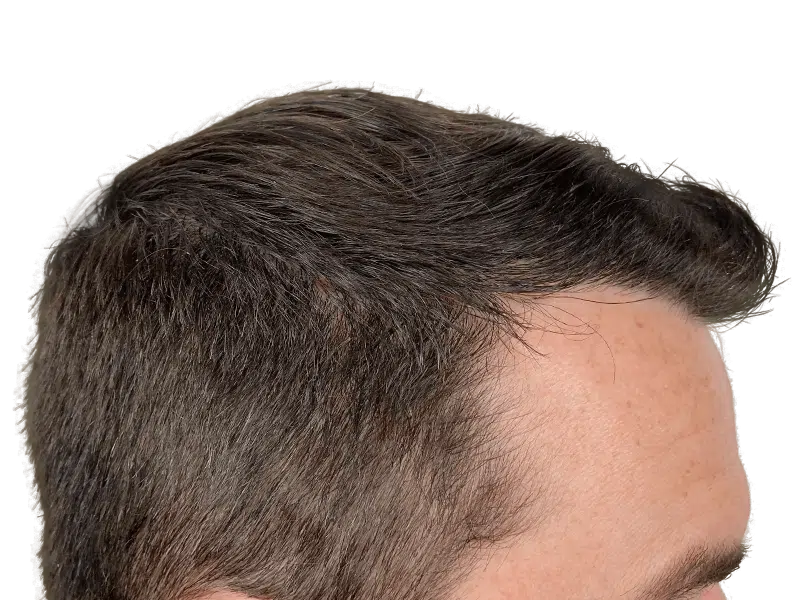 Receding hairline. Potential hair transplant candidate. Hair restoration before/after example. Dark brown hair, fair skin.