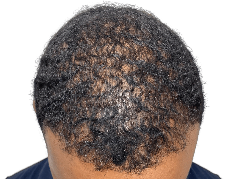 Hair thinning on dark, curly hair. Potential hair transplant candidate. Before/after comparison needed for assessment.