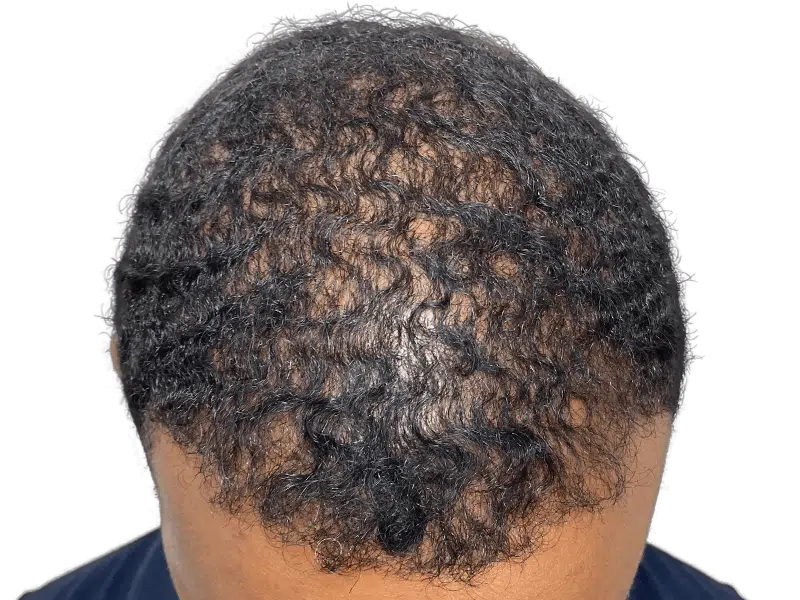 Hair thinning on dark, curly hair. Potential hair transplant candidate. Before/after comparison needed for assessment.