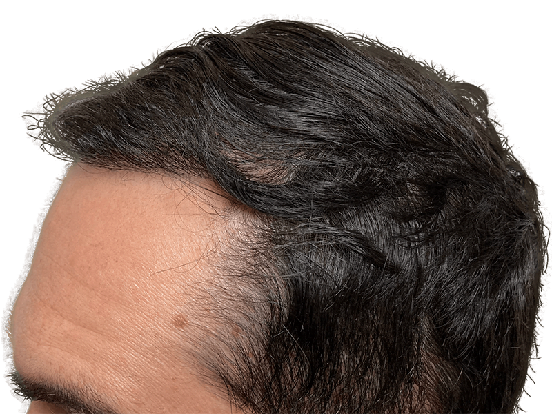 Hair transplant result: Caucasian man's improved hairline. Dense, dark hair restoration. Before & after potential.