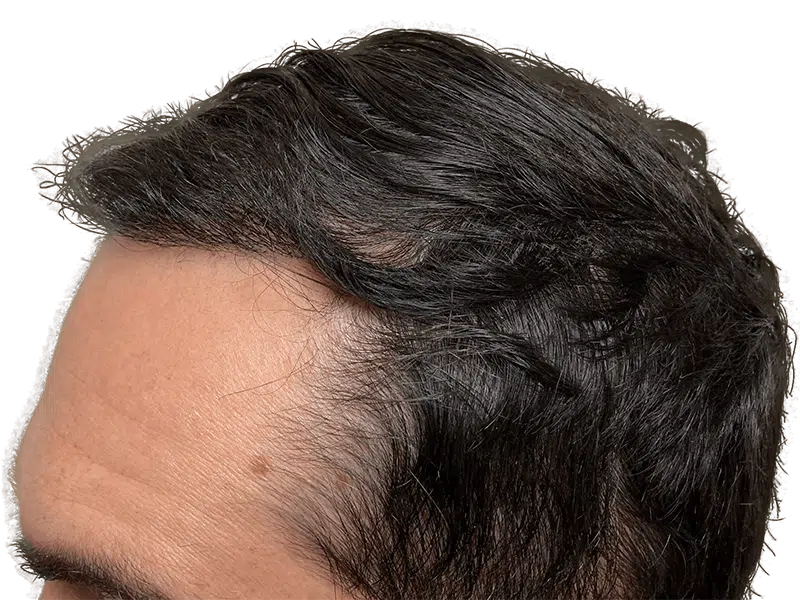 Hair transplant result: Caucasian man's improved hairline. Dense, dark hair restoration. Before & after potential.