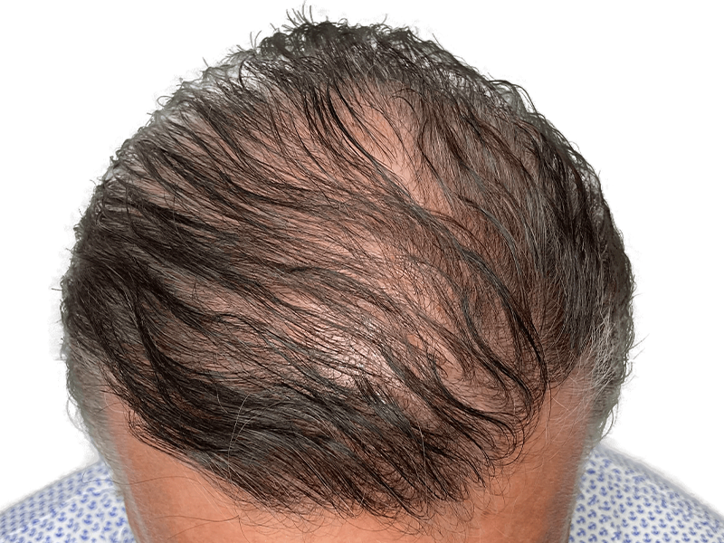 Thinning hair before restoration. Receding hairline, gray & brown hair. Hair transplant candidate. Before hair restoration.
