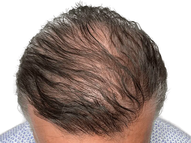Thinning hair before restoration. Receding hairline, gray & brown hair. Hair transplant candidate. Before hair restoration.
