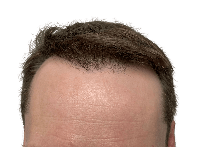 Receding hairline. Hair restoration candidate? Potential hair transplant before photo. Brown hair, male forehead.