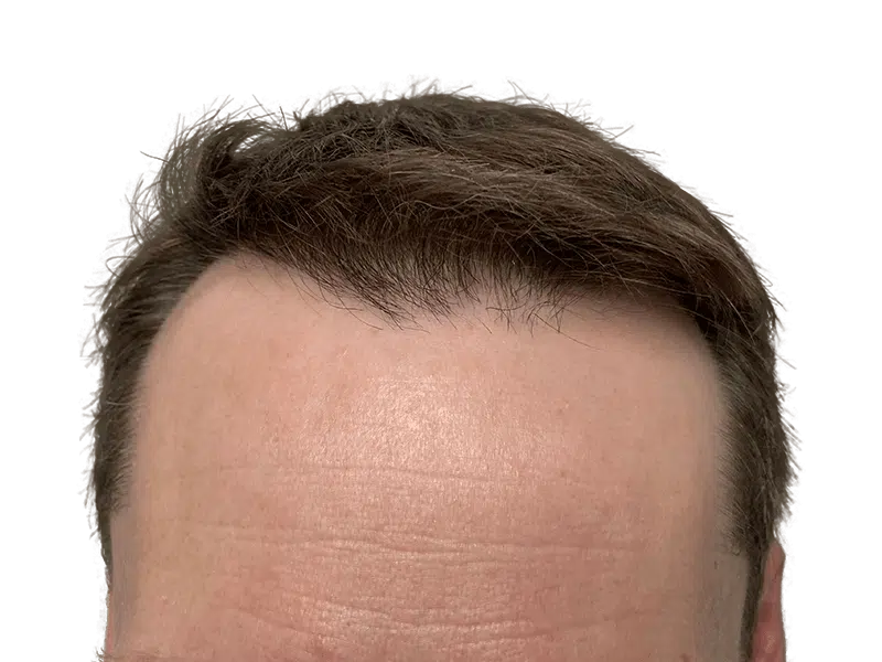 Receding hairline. Hair restoration candidate? Potential hair transplant before photo. Brown hair, male forehead.