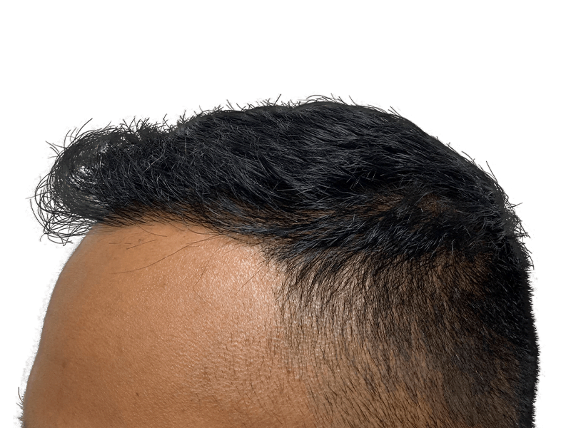 Hair transplant result: Dense, natural hairline restoration. Before & after hair loss solution.