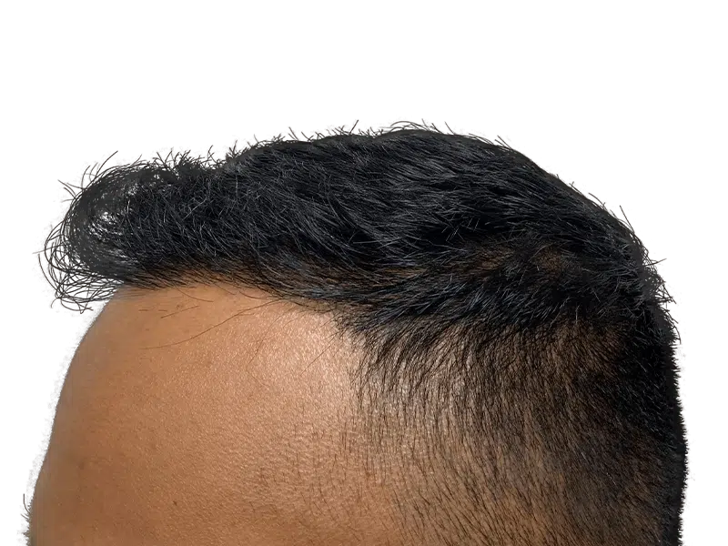 Hair transplant result: Dense, natural hairline restoration. Before & after hair loss solution.