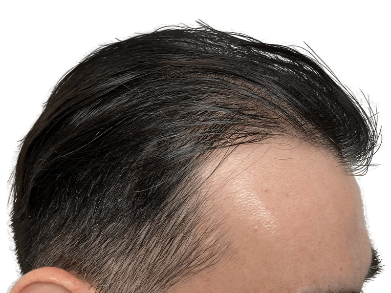 Asian man's hairline. Hair restoration candidate? Dark hair combed back. Consider hair transplant options.