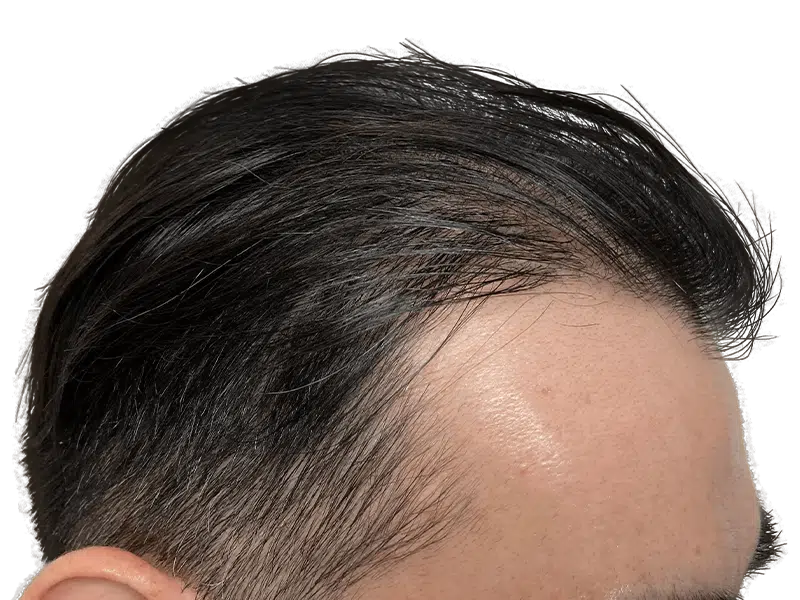 Asian man's hairline. Hair restoration candidate? Dark hair combed back. Consider hair transplant options.