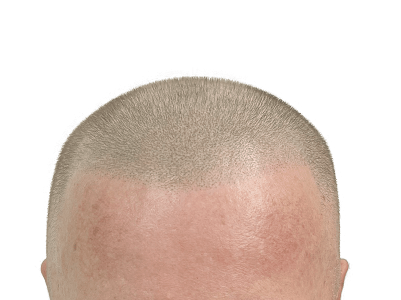 Hair restoration close-up: Man's scalp showing even hair growth after transplant. Light brown hair, fair skin. Before/after results possible.