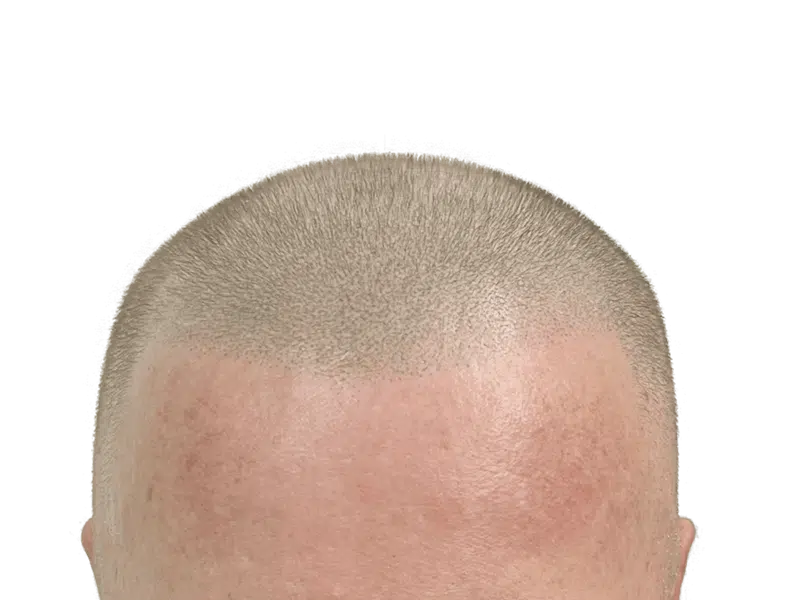Hair restoration close-up: Man's scalp showing even hair growth after transplant. Light brown hair, fair skin. Before/after results possible.