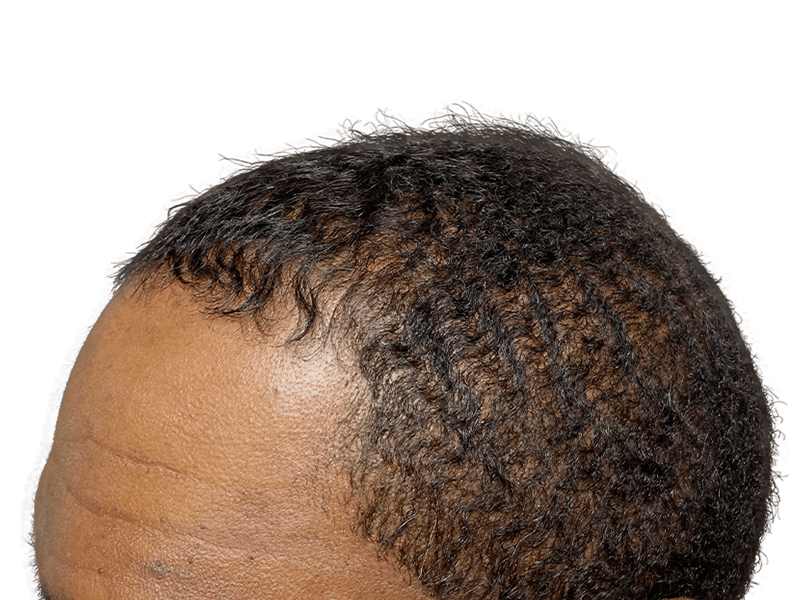 Hair transplant candidate: Close-up of thinning hairline. Dark, curly hair. Possible before/early regrowth stage. Hair restoration.