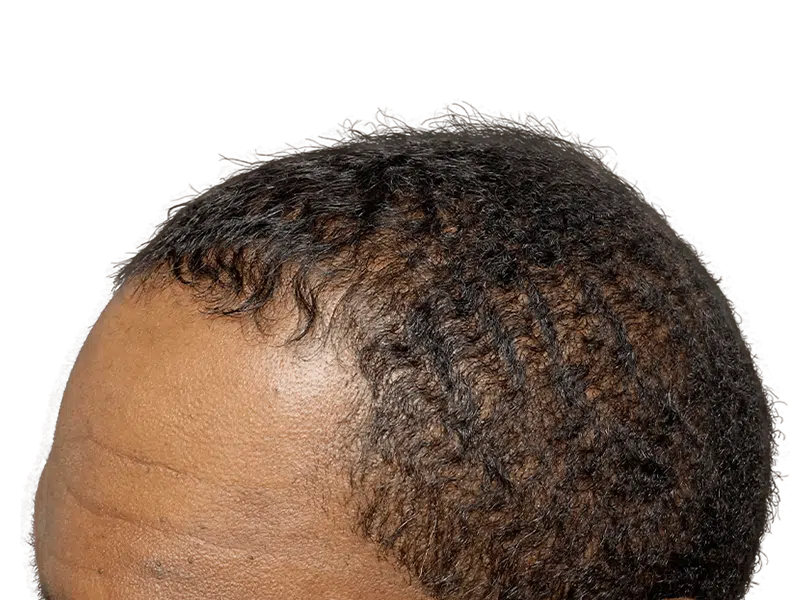 Hair transplant candidate: Close-up of thinning hairline. Dark, curly hair. Possible before/early regrowth stage. Hair restoration.