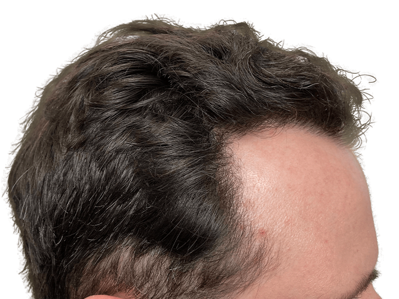 Receding hairline. Potential hair loss. Before hair restoration treatment. See hair transplant options.