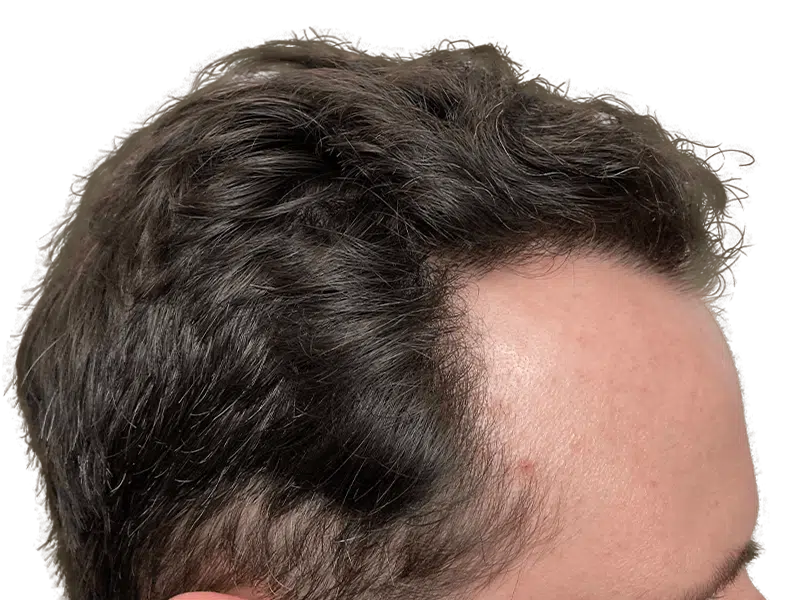Receding hairline. Potential hair loss. Before hair restoration treatment. See hair transplant options.