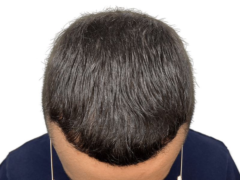 Thinning hair before restoration. Potential hair transplant candidate. Dark hair with graying on top.