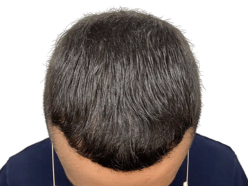 Thinning hair before restoration. Potential hair transplant candidate. Dark hair with graying on top.