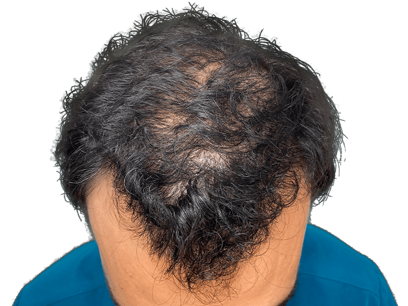 Before hair transplant: Thinning dark hair at crown. Hispanic man. Hair loss treatment results.
