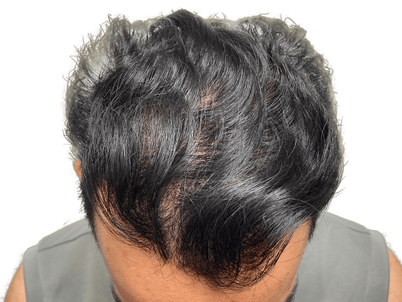 Thinning dark hair, possible hair loss. Could be a candidate for hair restoration or hair transplant procedure.