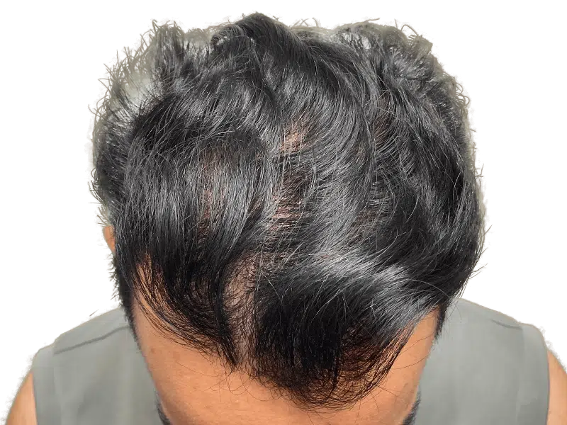 Thinning dark hair, possible hair loss. Could be a candidate for hair restoration or hair transplant procedure.