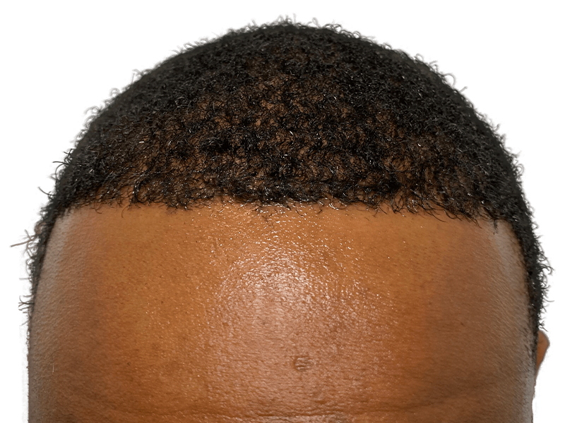 Before hair transplant: African American man's hairline. Dense, curly hair. Hair restoration candidate.