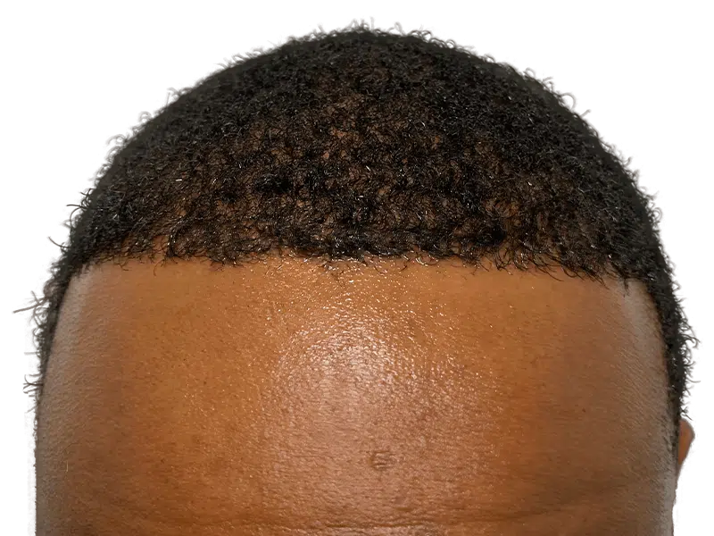 Before hair transplant: African American man's hairline. Dense, curly hair. Hair restoration candidate.